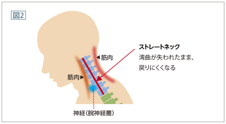 ストレートネック/湾曲が失われたまま、戻りにくくなる